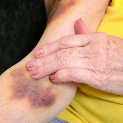 Old woman with visible bruised from nursing home negligence